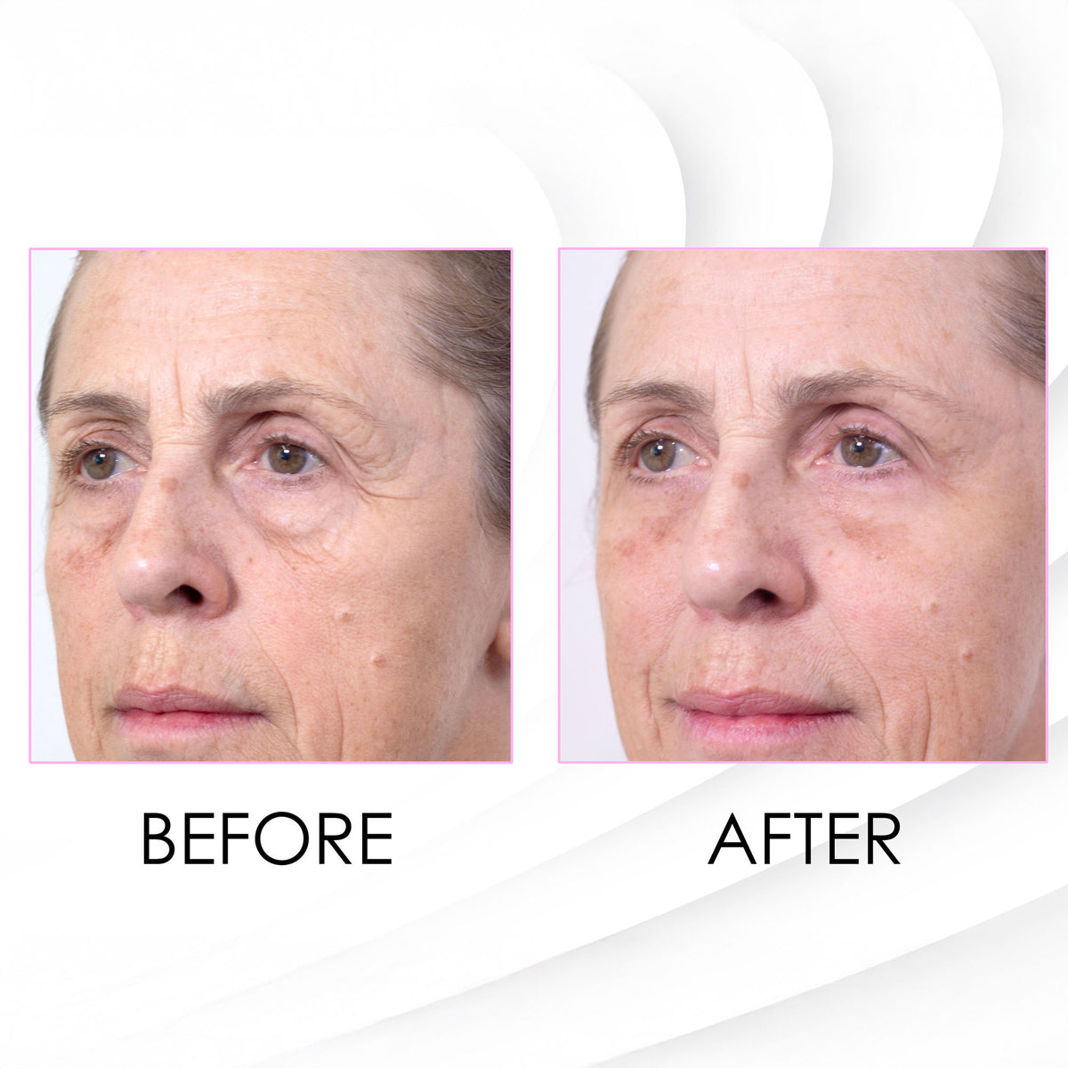 skinChemists Wrinkle Killer Instant Face Lift 5 x 2ml